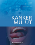 Kanker Mulut